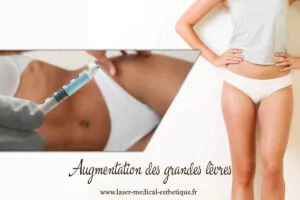 Injection d’acide hyaluronique fessier Augmentation des grandes lèvres