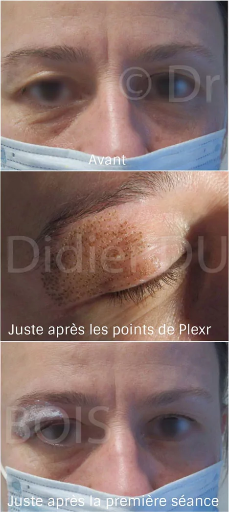 Blépharoplastie médicale sans chirurgie, au Plexr