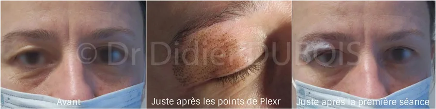 Blépharoplastie médicale sans chirurgie