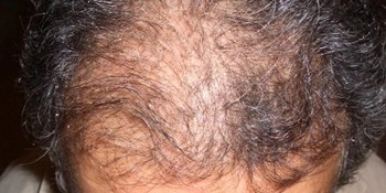 Chute de cheveux et mesotherapie thumbs