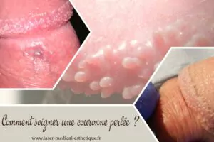 Traitement des acrochordons génitaux Comment soigner une couronne perlée