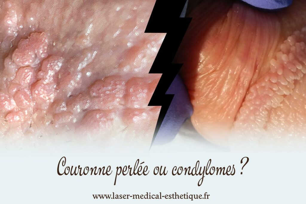 Couronne perlée ou condylomes ? Couronne perlée ou condylomes