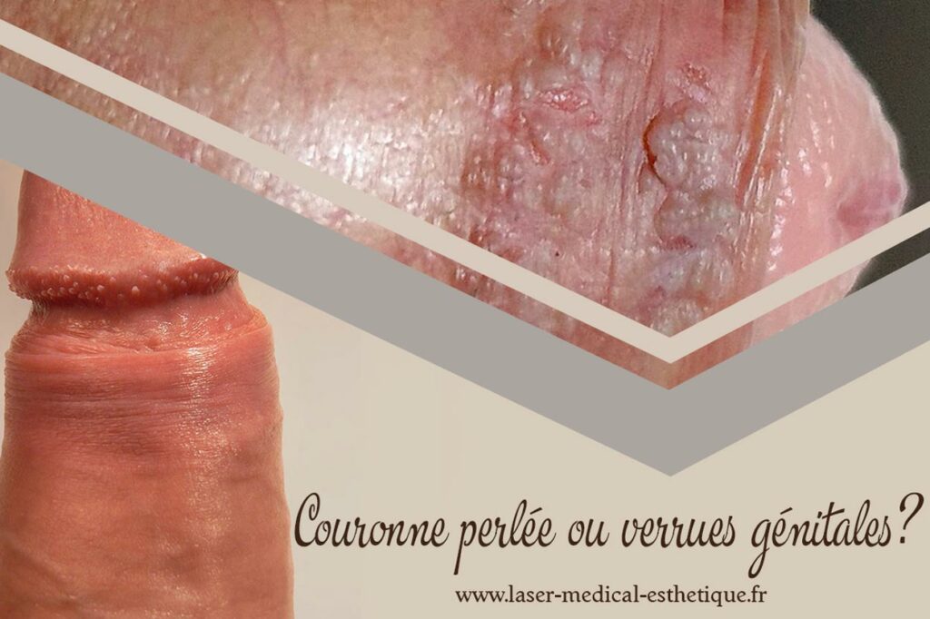 Couronne perlée ou verrues génitales