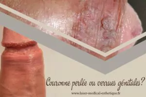 Couronne perlée ou verrues génitales