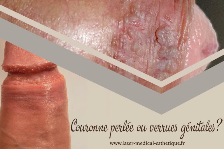 Couronne perlée ou verrues génitales