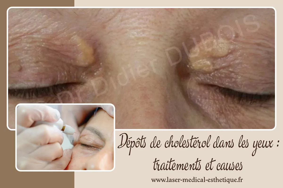 Dépôts de cholestérol dans les yeux : traitements et causes Dépôts de cholestérol dans les yeux
