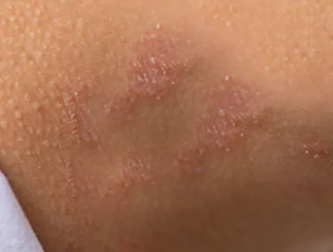 Dermatite au niveau du pénis