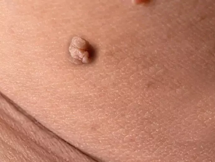 Des petites excroissances cutanées