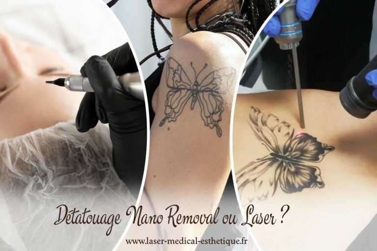 Détatouage NanoRemoval ou laser