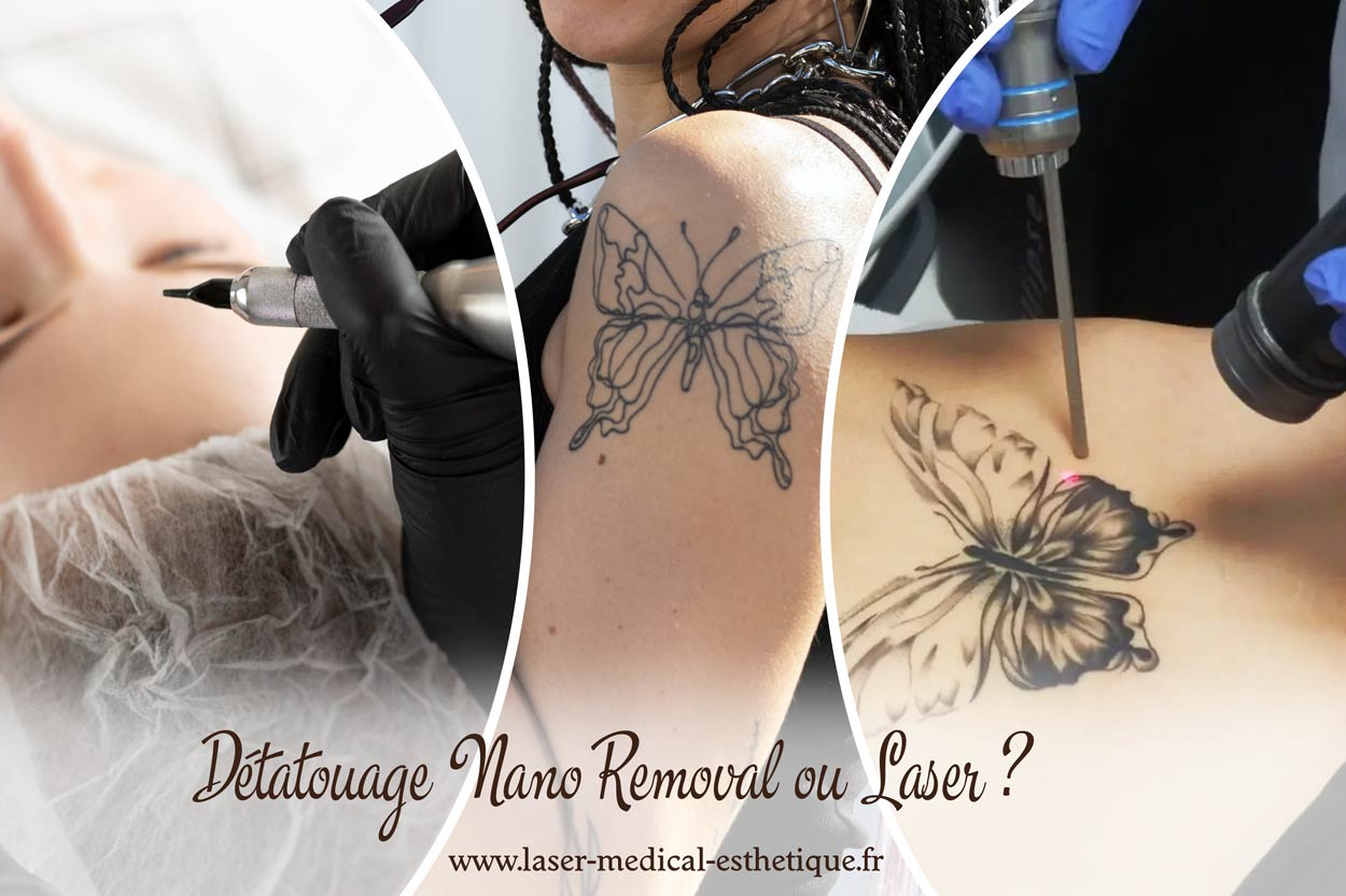 Détatouage NanoRemoval ou laser