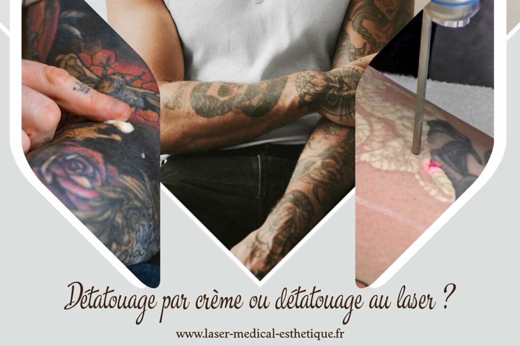 Détatouage par crème ou détatouage au laser