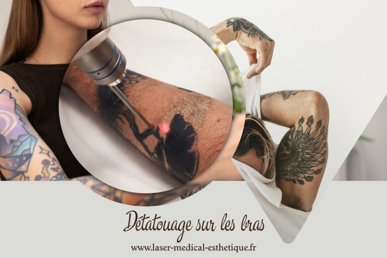 Détatouage sur les bras