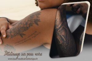 Détatouage sur peau noire