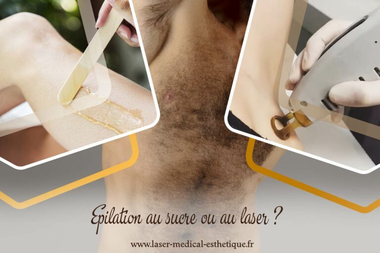 Epilation au sucre ou au laser
