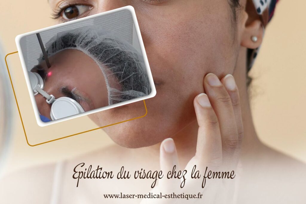 Epilation du visage chez la femme Epilation du visage chez la femme