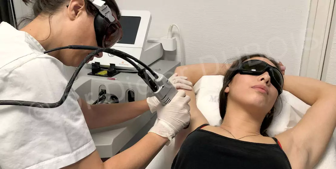 Epilation laser à Angers