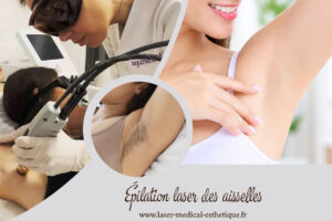 Traitement de la transpiration excessive des aisselles Épilation laser des aisselles au cabinet du Dr Didier Dubois