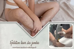 Épilation laser homme : zones, nombre de séances, prix et résultats Epilation laser des jambes au cabinet du Dr Didier Dubois