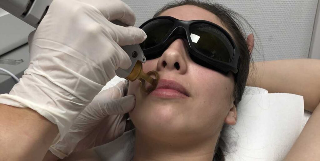 Epilation laser du visage au centre laser médical esthétique du Dr Dubois à Angers Epilation laser des lèvres du visage
