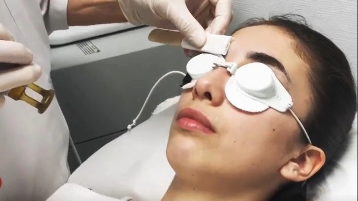 Epilation laser des sourcils