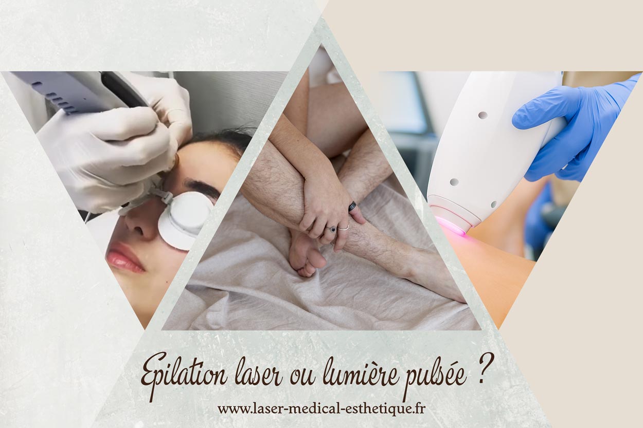 Epilation laser ou lumière pulsée ? Epilation laser ou lumière pulsée