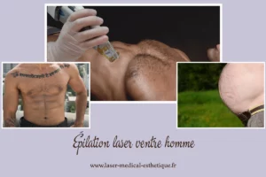 Epilation laser ventre homme