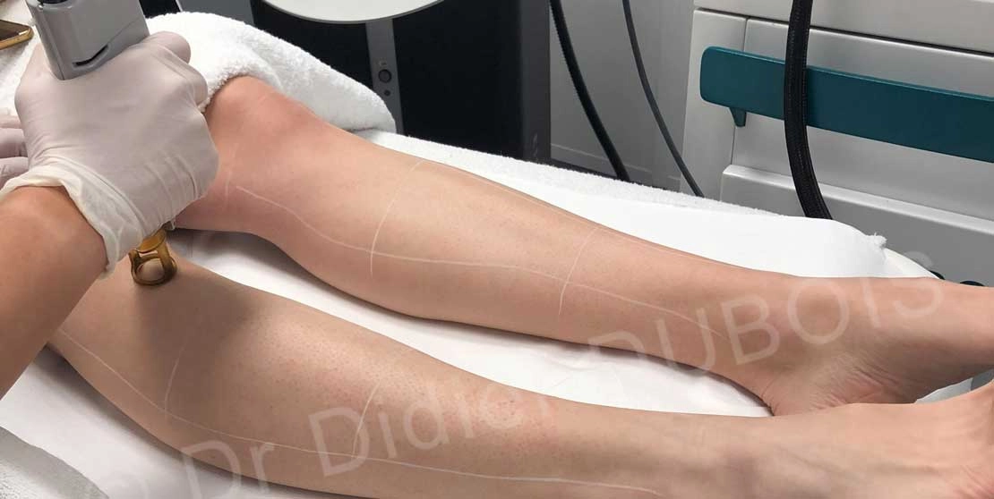 Epilation laser​ jambe