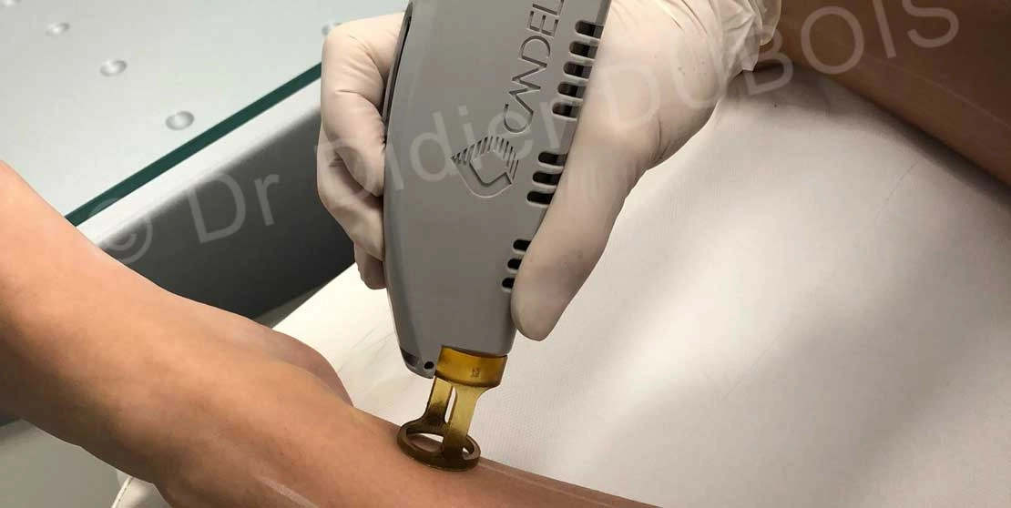 Epilation laser​ jambes