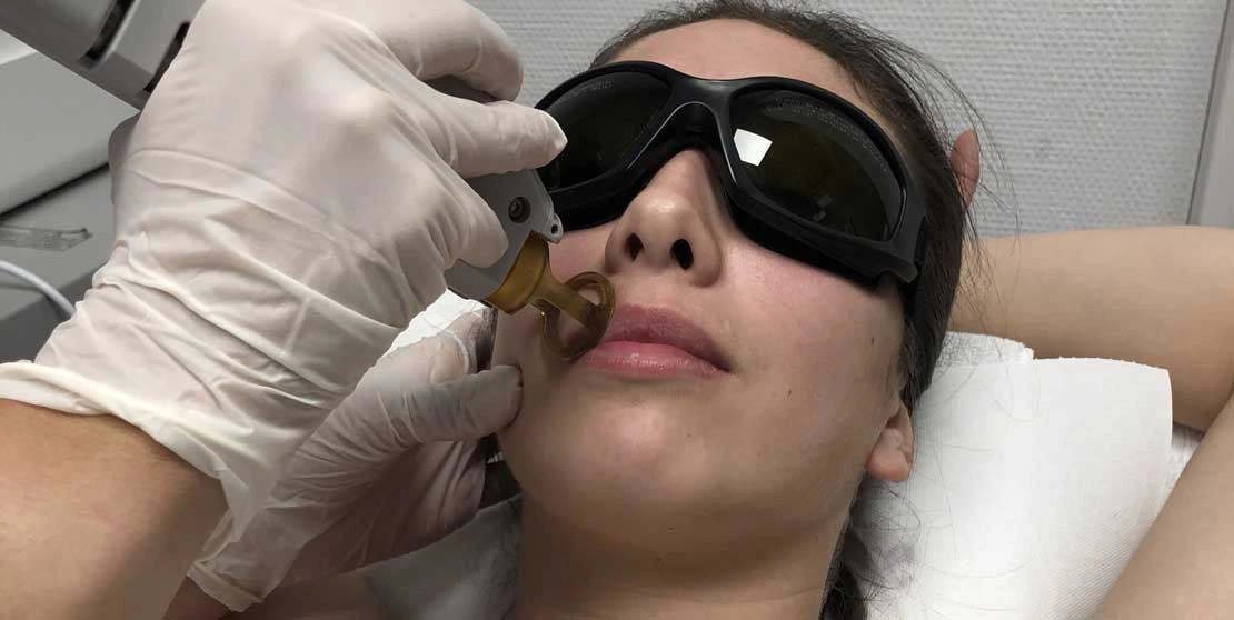 Epilation laser​ lèvre