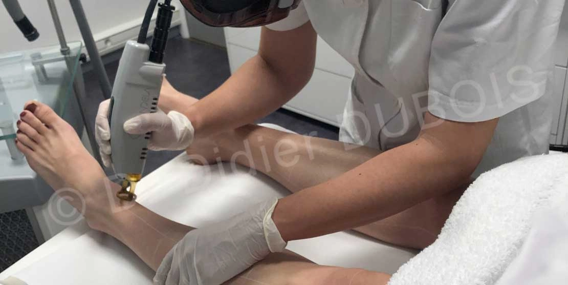 Epilation laser​ pied