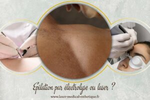 Epilation par électrolyse ou laser