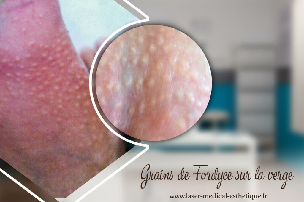 Grains de Fordyce sur la verge : Quels traitements ? Grains de Fordyce sur la verge