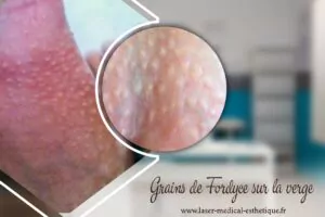 Grains de Fordyce sur la verge