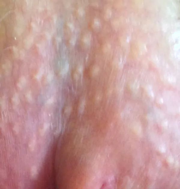 Grains de Fordyce sur la vulve