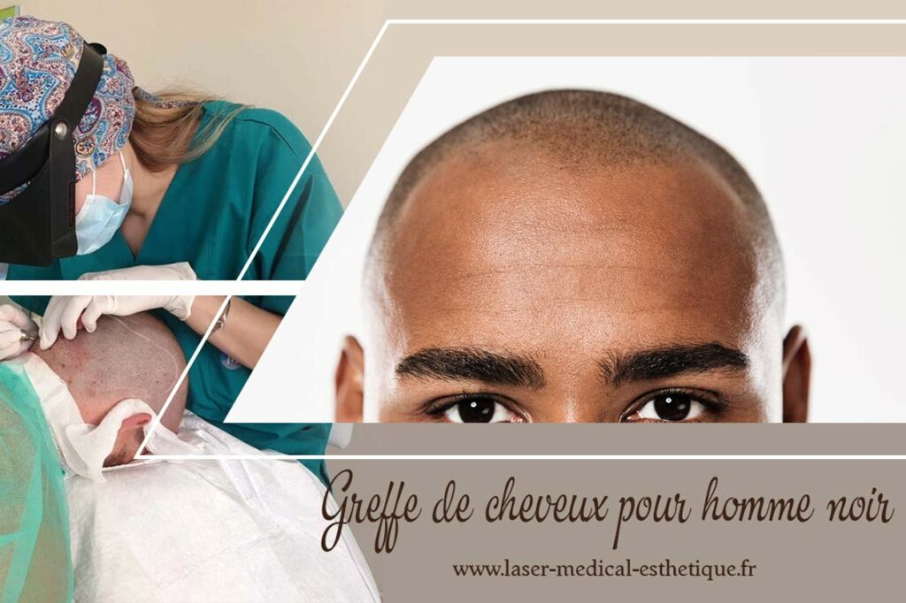 Greffe de cheveux pour homme noir