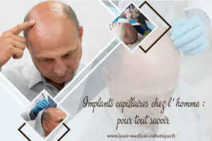 Greffes de cheveux sans chirurgie Implants capillaires chez l'homme