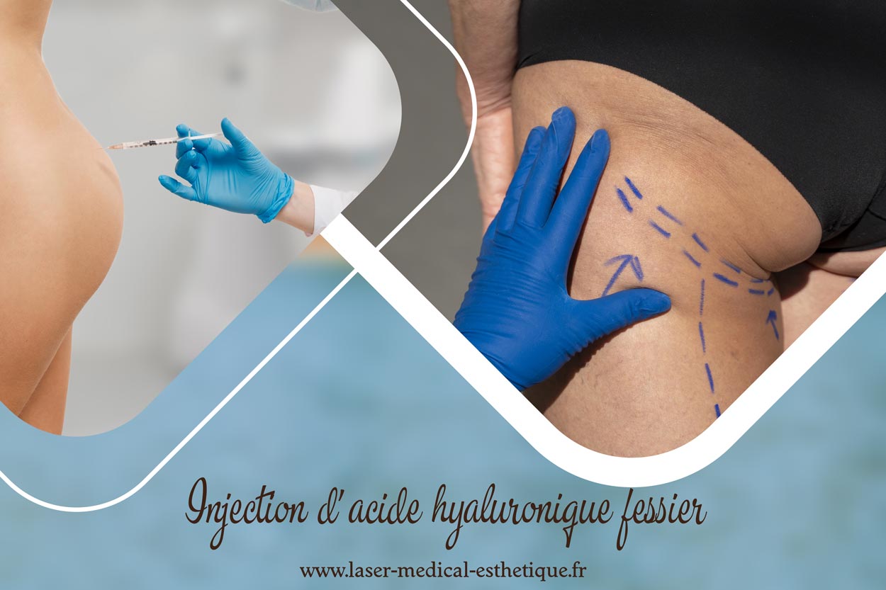 Injection d’acide hyaluronique fessier chez le docteur Didier Dubois