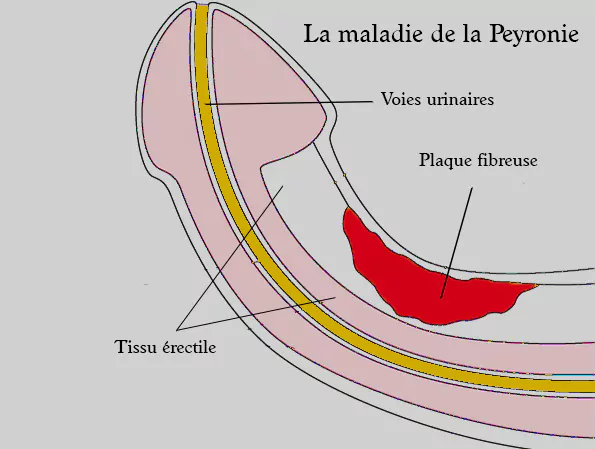 La maladie de La Peyronie