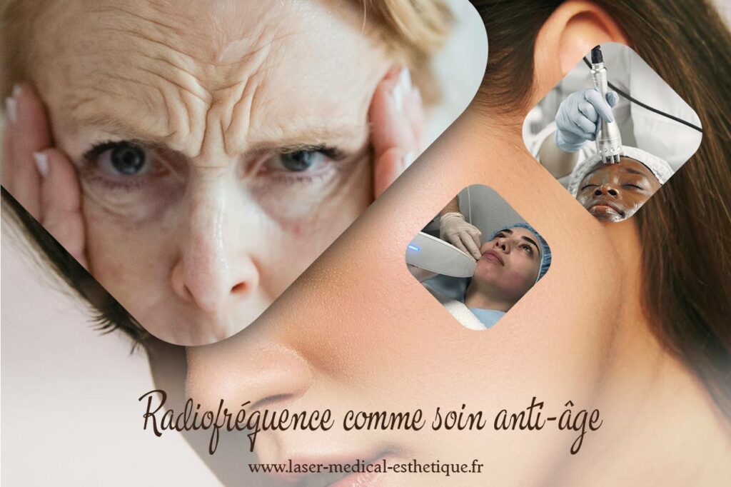 La radiofréquence comme soin anti-âge