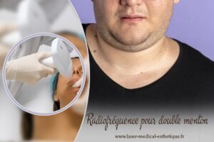 La radiofréquence pour double menton