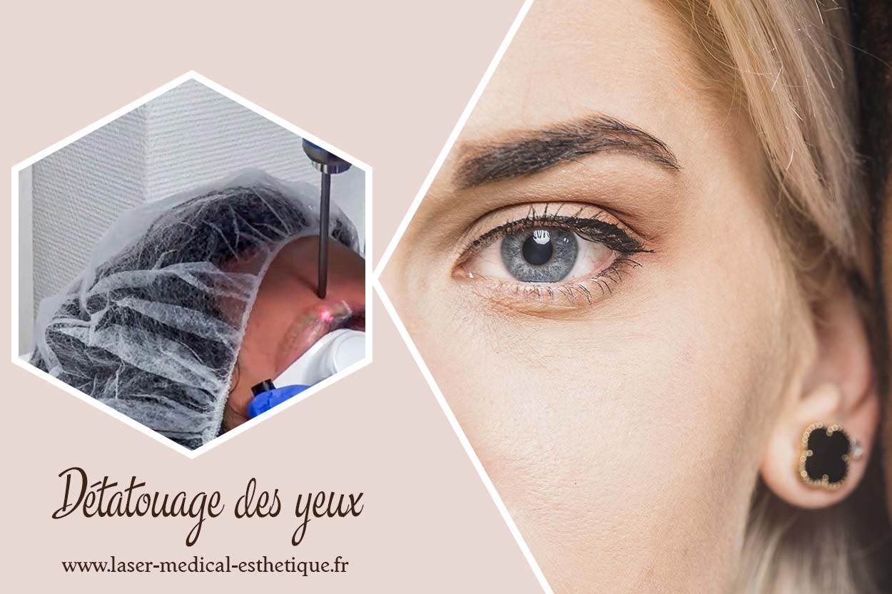 Détatouage des yeux : est-ce possible ? Le détatouage du tour des yeux