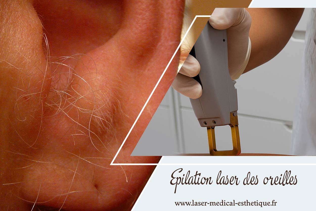 Epilation laser des oreilles L'épilation laser des oreilles