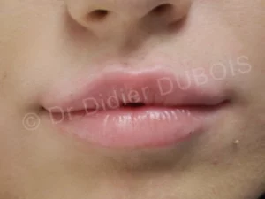 Lèvres pulpeuses juste patient 18 2-