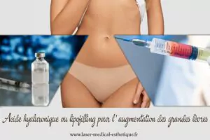 Lipofilling pour l'augmentation des grandes lèvres
