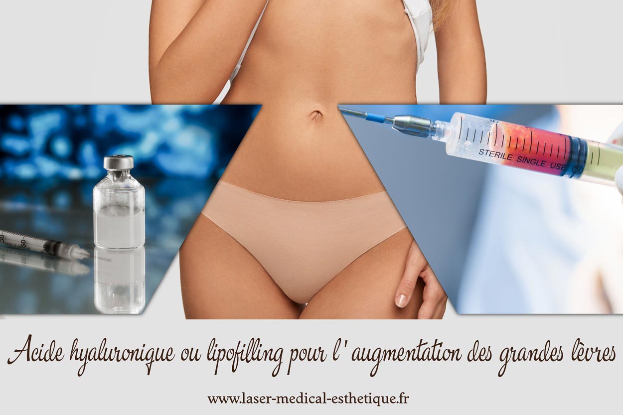 Lipofilling pour l'augmentation des grandes lèvres
