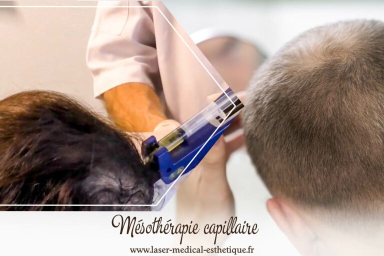 Centre Laser Médical Esthétique - Dr Didier Dubois à Angers Mésothérapie capillaire