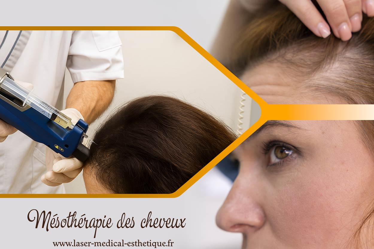 Mésothérapie des cheveux : pour tout savoir Mésothérapie des cheveux