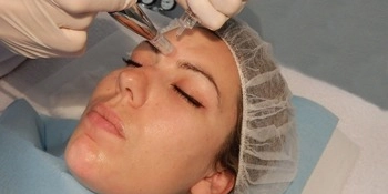 Microneedling ou micropuncture