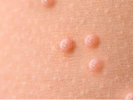 Molluscum contagiosum du pubis