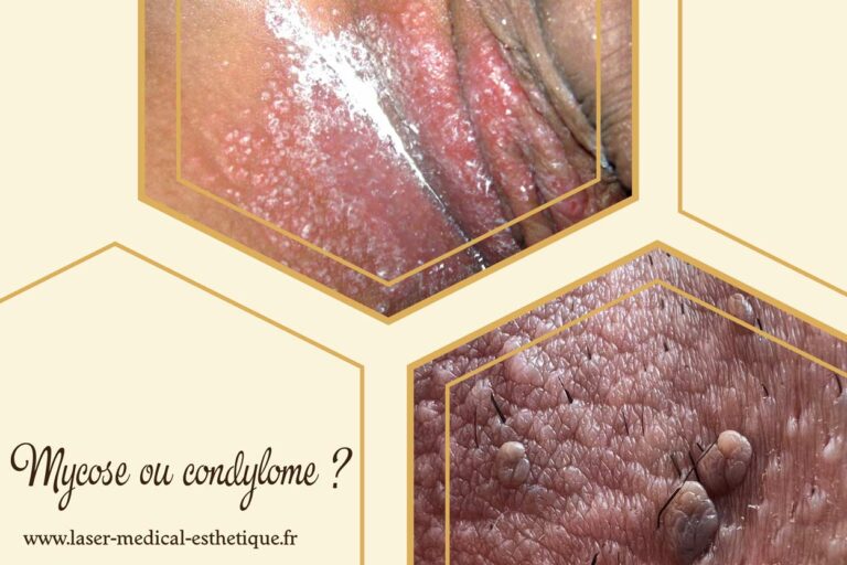 Mycose ou condylome